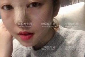 上海安縵醫(yī)美隆鼻怎么樣？術(shù)前術(shù)后經(jīng)驗分享！