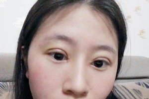 南昌大學(xué)美容醫(yī)院切開(kāi)雙眼皮是正規(guī)嗎？附果圖&價(jià)格表