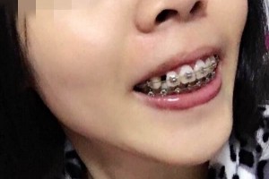 北京億大口腔醫(yī)院牙齒矯正怎么樣？附較新價(jià)格表！